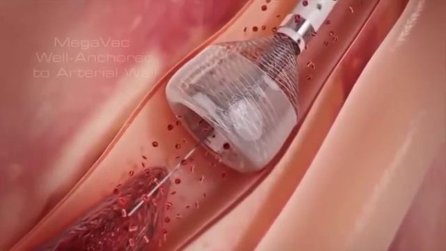 Вены. Удаление варикоза смотреть онлайн