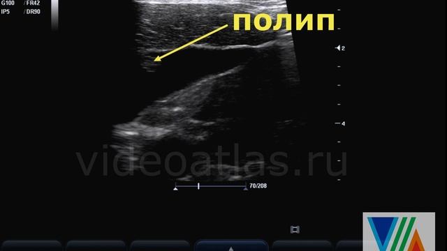 Полип на стенке ЖП. Еще пример смотреть онлайн