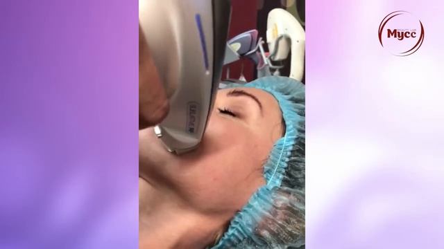 Элос RF лифтинг смотреть онлайн