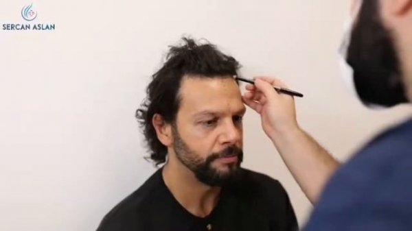 Пересадка методом DHI