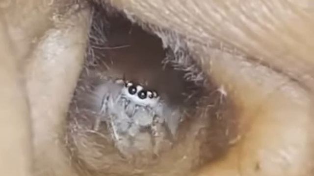 Паук скакун поселился в ухе женщины