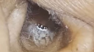 Паук скакун поселился в ухе женщины