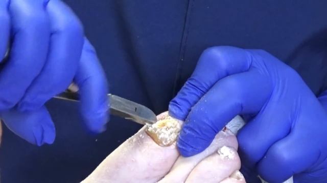 Trimming Thick Toenails (2020)