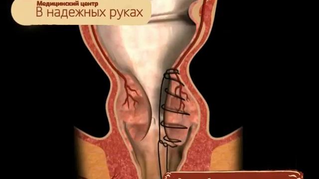 Прошивание геморроидальных сосудов.avi смотреть онлайн
