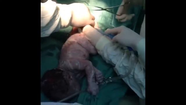 Cesarean section - Step by step смотреть онлайн