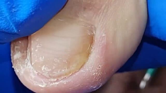 Carefully separate the ingrown nail from the nail bed【Xue Yidao】 смотреть онлайн