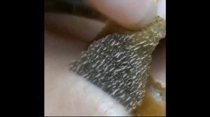 Выдавливание Чёрных Точек и Угрей на носу ! ЧИСТКА ЛИЦА / Прыщи / Nose Blackheads Squeezing