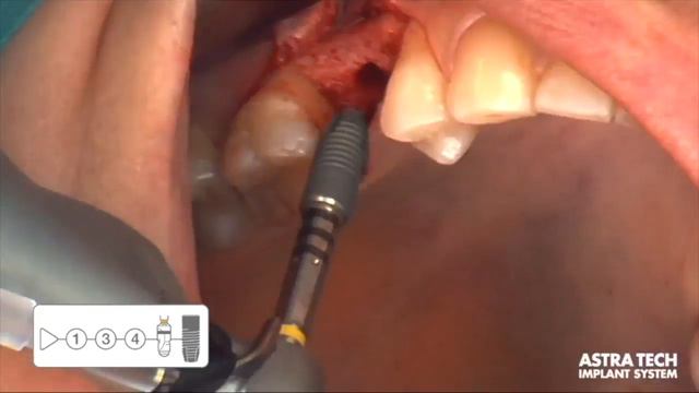 Implant Placement смотреть онлайн