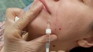 АирисКом студенты учатся: заполнение носогубной складки филлером.
