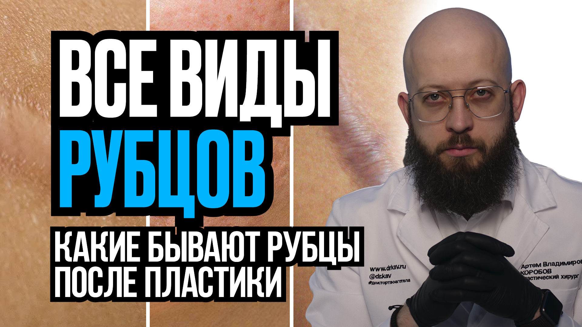 Виды рубцов и шрамов после пластических операций смотреть онлайн