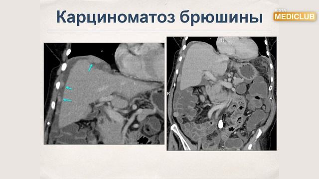 Роль КТ в стадіюванні раку ободової кишки смотреть онлайн