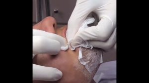 подборка выдавливания прыщей 30 II выдавливание прыщей