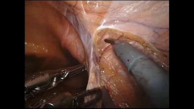Robotic Retroperitoneal Lymph Node Dissection смотреть онлайн