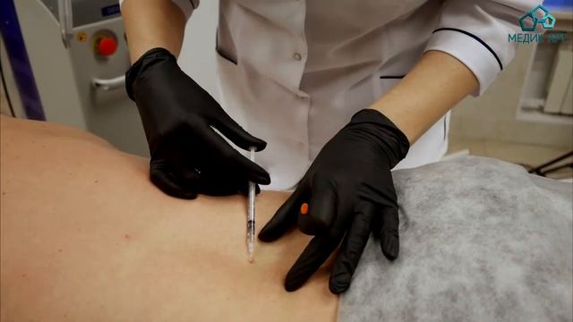 Удаление родинок на аппарате Smart Xide Touch CO2 в клинике Медик Арт смотреть онлайн