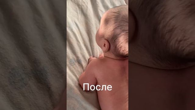 Кривошея до и после.Держит головку.