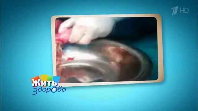 Аскариды внутри человека. смотреть онлайн