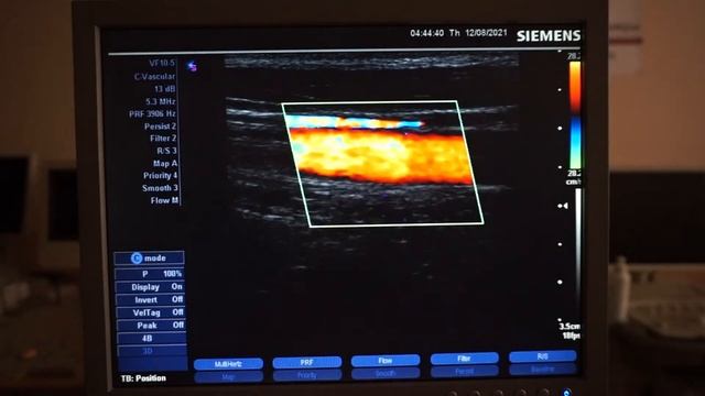 Siemens Sonoline G40 обзор ультразвукового сканера