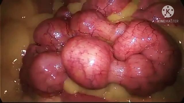 Перистальтика—это серия упорядоченных сокращений кишечника, которые проталкивают пищу через кишечни смотреть онлайн