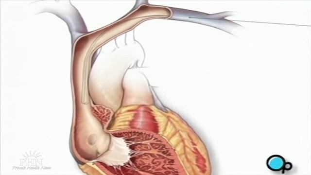 Имплантация кардиостимулятора смотреть онлайн
