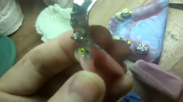 Бюгельный протез на замках