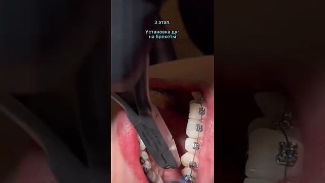 Девушка исполнила свою мечту! Первая реакция на брекеты. смотреть онлайн