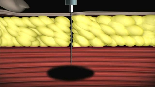 Anvil Media | Intramuscular injection training video смотреть онлайн