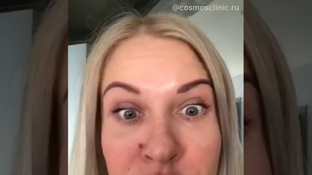 Ботулинотерапия (Ботокс, Botox) – до и после