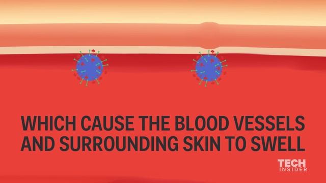 The best way to treat a mosquito bite смотреть онлайн