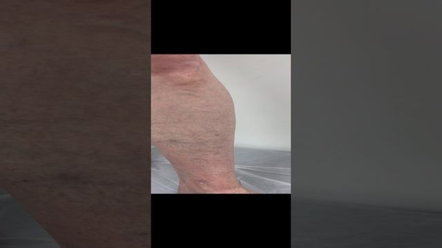 Варикоз у женщины. Как лечить варикоз? Лечение варикоза. Флеболог. Флеболог Москва смотреть онлайн