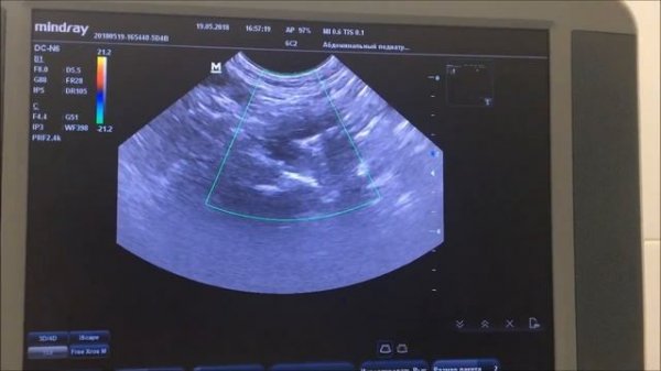 Настройка аппаратуры mindray