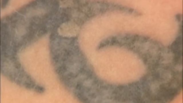 Laser tattoo removal with Multiline Q-sw смотреть онлайн