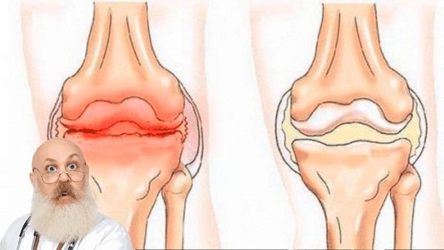 Лечение суставов, радикулита пиявками Методика, типичные ошибки смотреть онлайн