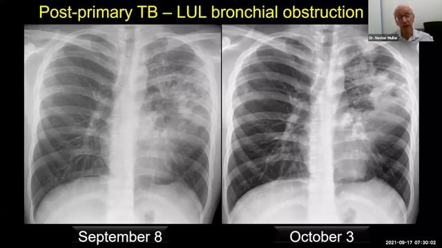 Imaging of Pulmonary Tuberculosis смотреть онлайн