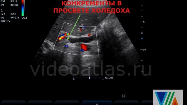 Камень в холедохе смотреть онлайн