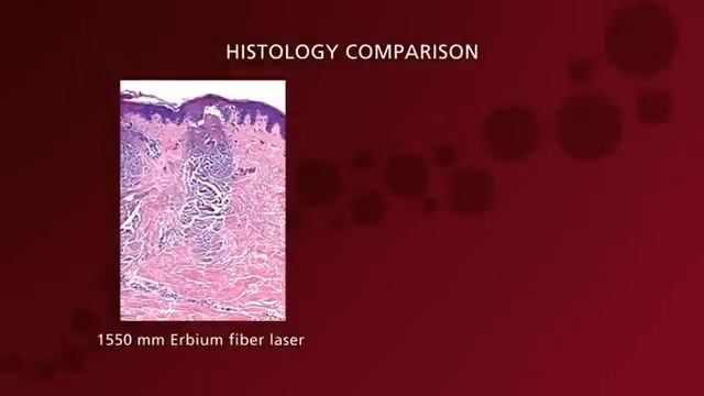 Процедура FRAXEL re:store DUAL смотреть онлайн