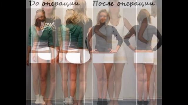 ХИРУРГИЧЕСКОЕ ИСПРАВЛЕНИЕ КРИВИЗНЫ НОГ смотреть онлайн