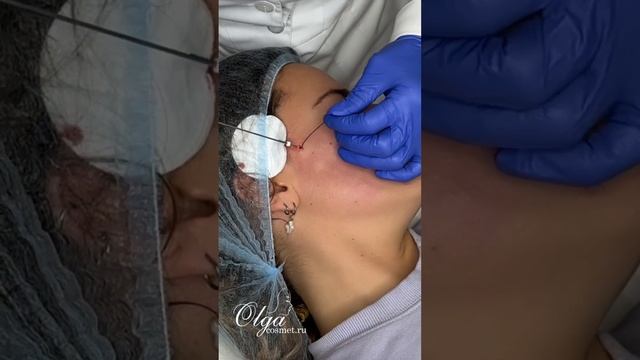 Нити ког предотвращают провисание тканей. #косметологбалашиха #косметологжелезнодорожный смотреть онлайн