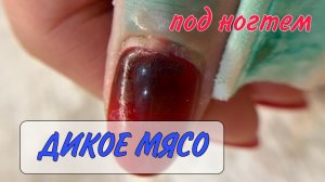 😱мясо под ногтем _ 📌пиогенная гранулёма_ 💥трещина на ногте