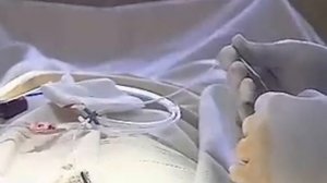 Катетеризация подключичной вены