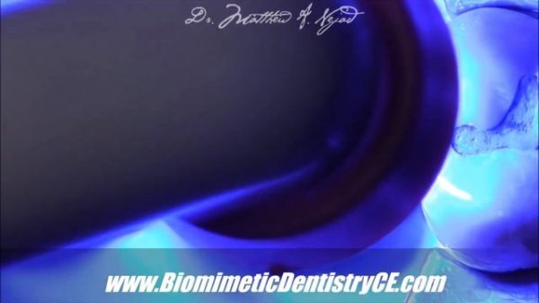 Biomimetic Dentistry- Immediate Dentin Sealing with Self-Etch DBA