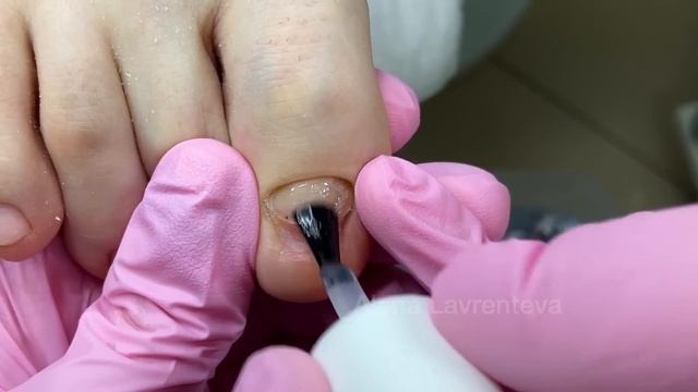 Проблемный ноготь Ноготь не прирастает что делать? Ноготь на ноге не растет Экзостоз? Зачистка ногт