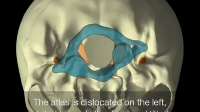 AtlasPROfilax (Атласпрофилакс) - общие сведения о первом шейном позвонке Атланте