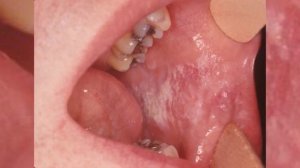 Кандидозный и афтозный стоматит: фото на языке во рту, на десне, нёбе, горле, губах