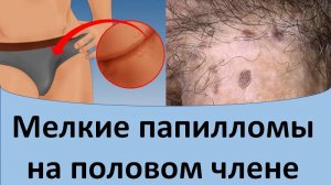 Мелкие папилломы на половом члене