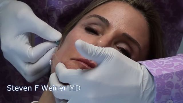 PDO Thread Lift with Novathreads - New Minimally Invasive Lifting смотреть онлайн