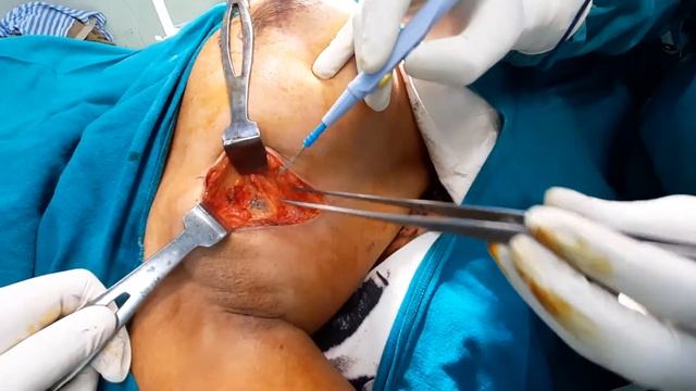 Sentinel node biopsy with breast conservative surgery in early breast cancer смотреть онлайн