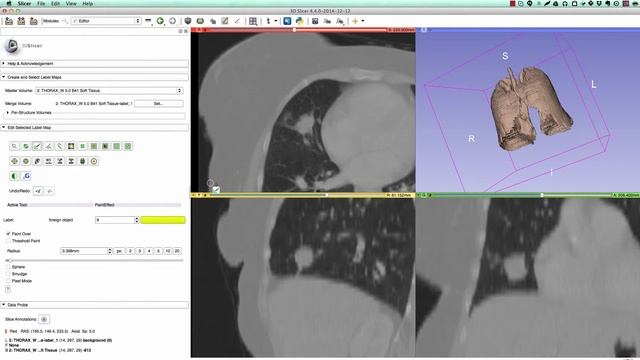 Segmentation of lung and nodule in CT using 3D Slicer смотреть онлайн