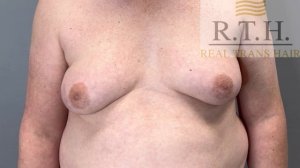 Женская грудь у мужчин. Метод лечения.