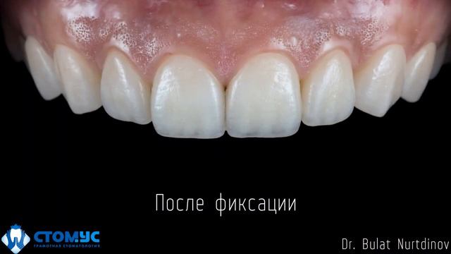 Виниры без обточки зубов смотреть онлайн