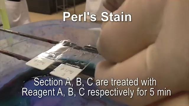 Perl's stain for hemosiderin смотреть онлайн